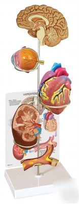 Hypertension organ set anatomical models #4000 frees&h*