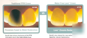 3M espe lava coping zirconia all ceramic